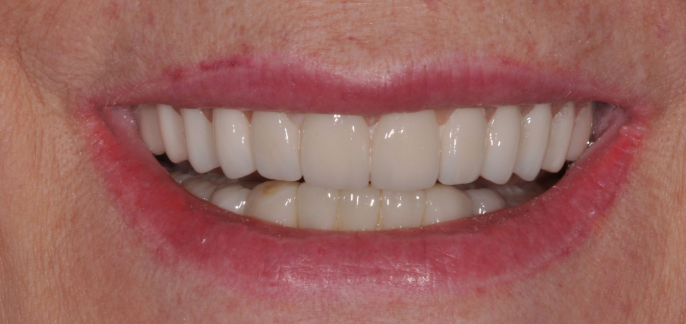 Denture A2