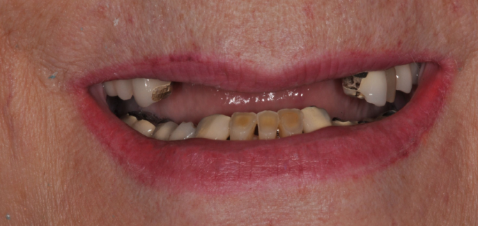 Denture B2