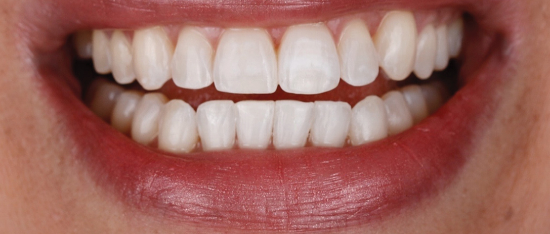 Invisalign A