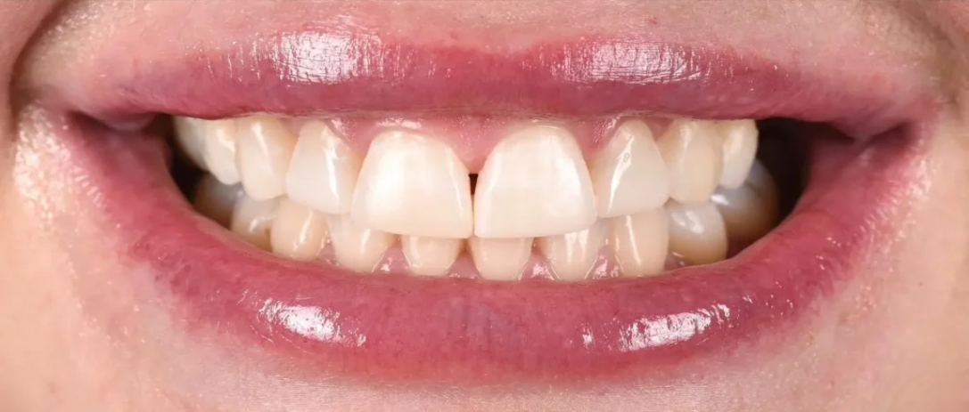 Invisalign A1