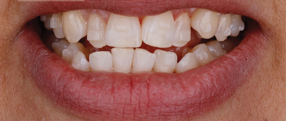 Invisalign B