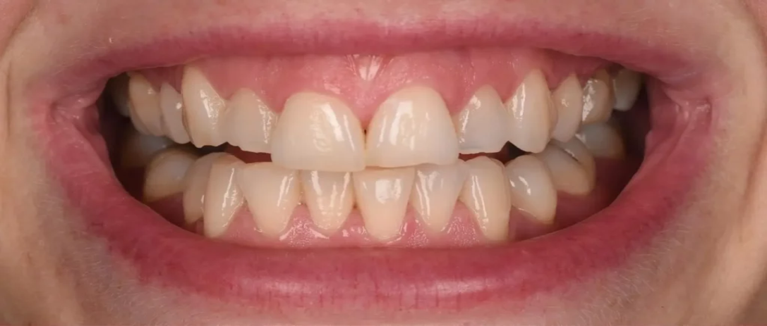 Invisalign B1