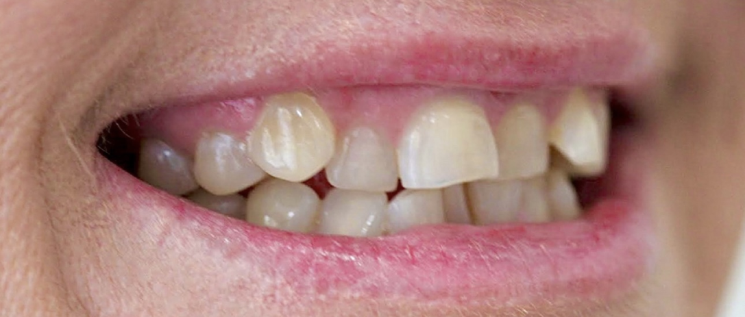 Invisalign B2