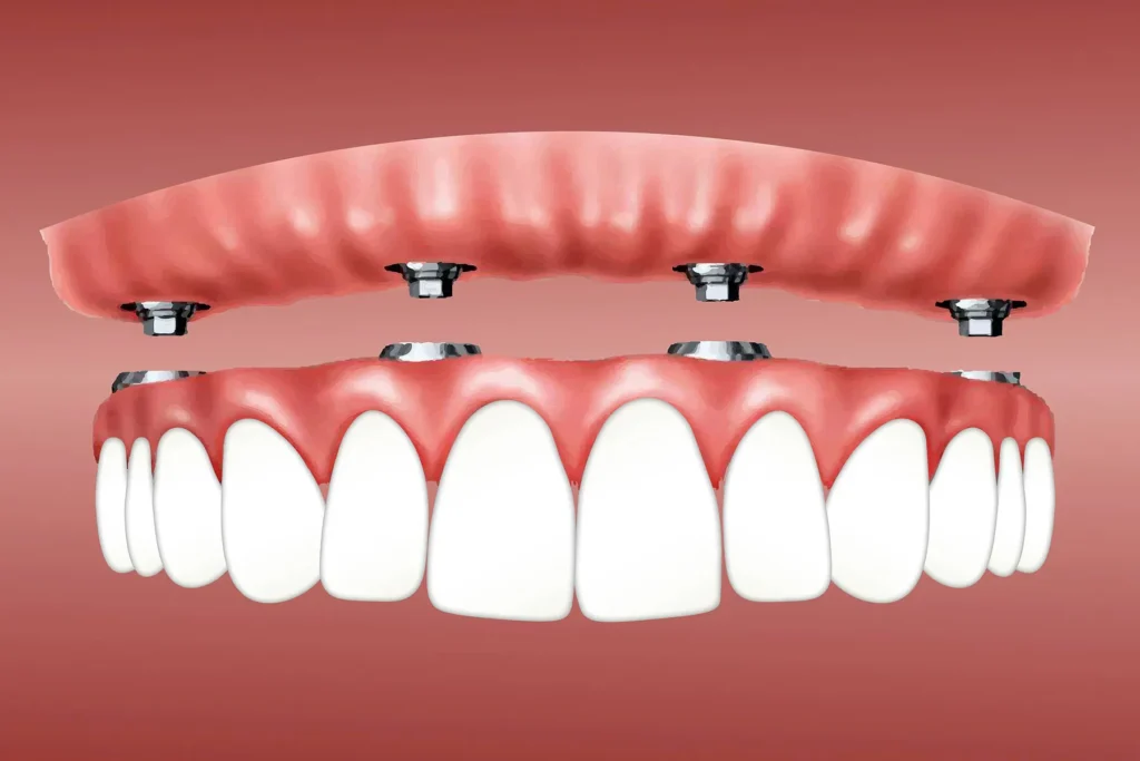 Snap on Denture/ Overdenture