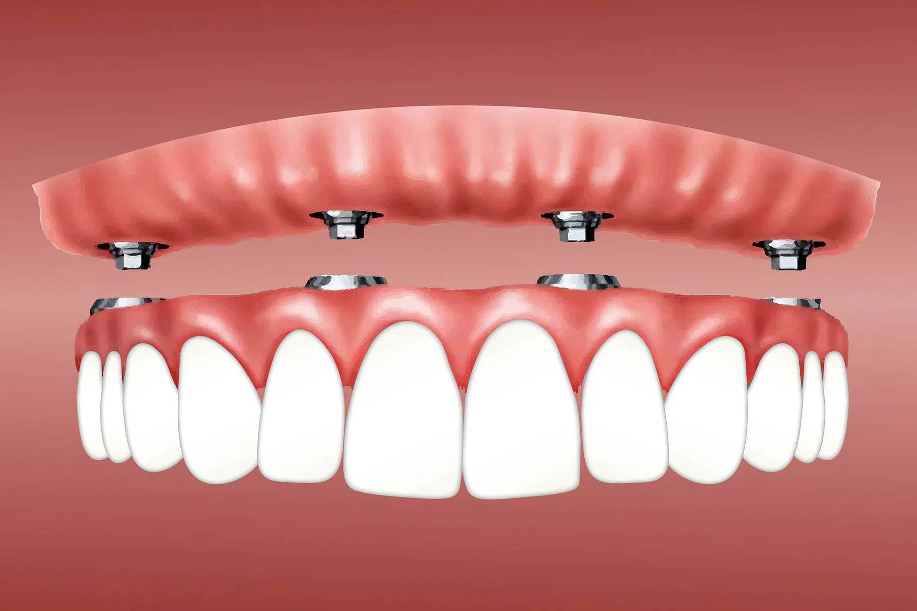 Snap on Denture/ Overdenture