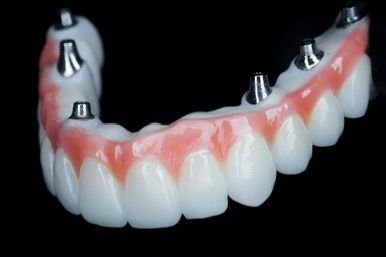 Missing or damaged teeth can affect your confidence, comfort, and quality of life. At Procare Dental Studio, we offer advanced implant dentistry and oral surgery treatments designed to restore both the health and beauty of your smile in a calm, modern environment. From gentle tooth extractions and wisdom tooth removal to bone grafting, dental implants, implant restorations, snap-on dentures, and All-on-X full arch rehabilitation, Dr. Sheikh combines advanced technology with personalized care to create functional, natural-looking, and long-lasting results tailored to every patient.