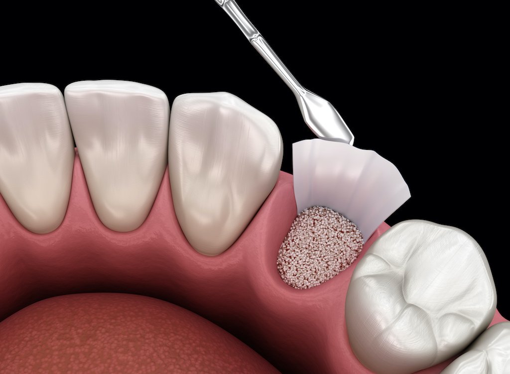 Bone Grafting