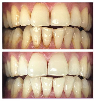 Dental Exams & Cleaning in Mckinney TX