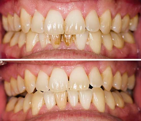Dental Cleaning in Mckinney TX