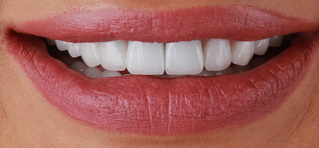Natural-looking smile after dental implant restoration in McKinney, TX