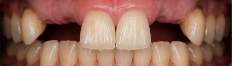 Smile with a missing front tooth before a single dental implant