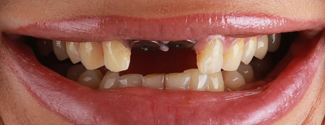Close-up of a missing upper tooth before dental implant placement