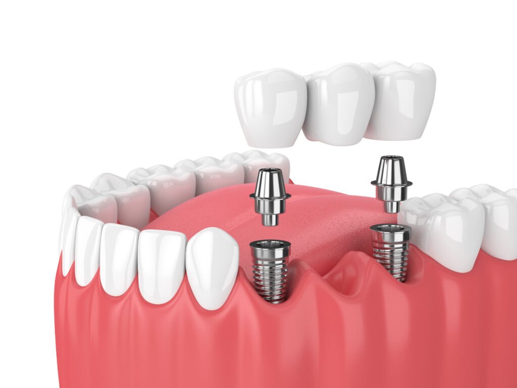 Dental Implant
