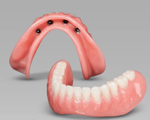 Snap on Denture in Mckinney TX