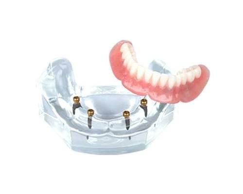 Full Dentures in Mckinney TX