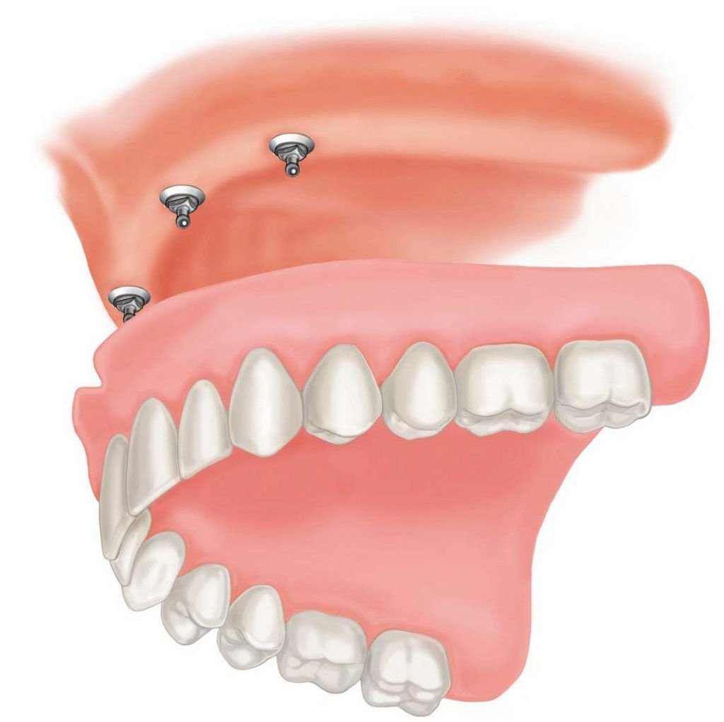 Full and partial Dentures in Mckinney TX