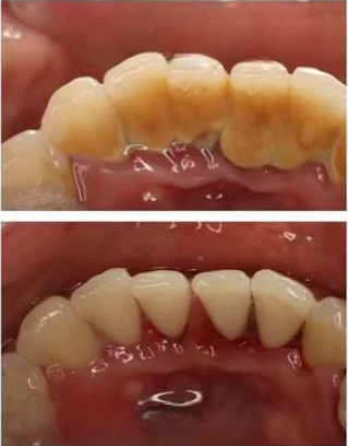 Gum Therapy Treatment