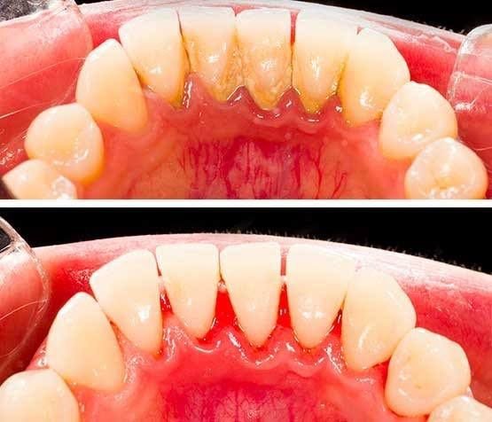 Gum therapy in mckinney TX