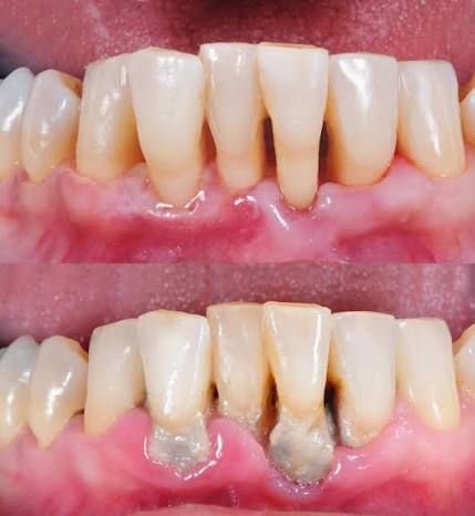 Gum therapy