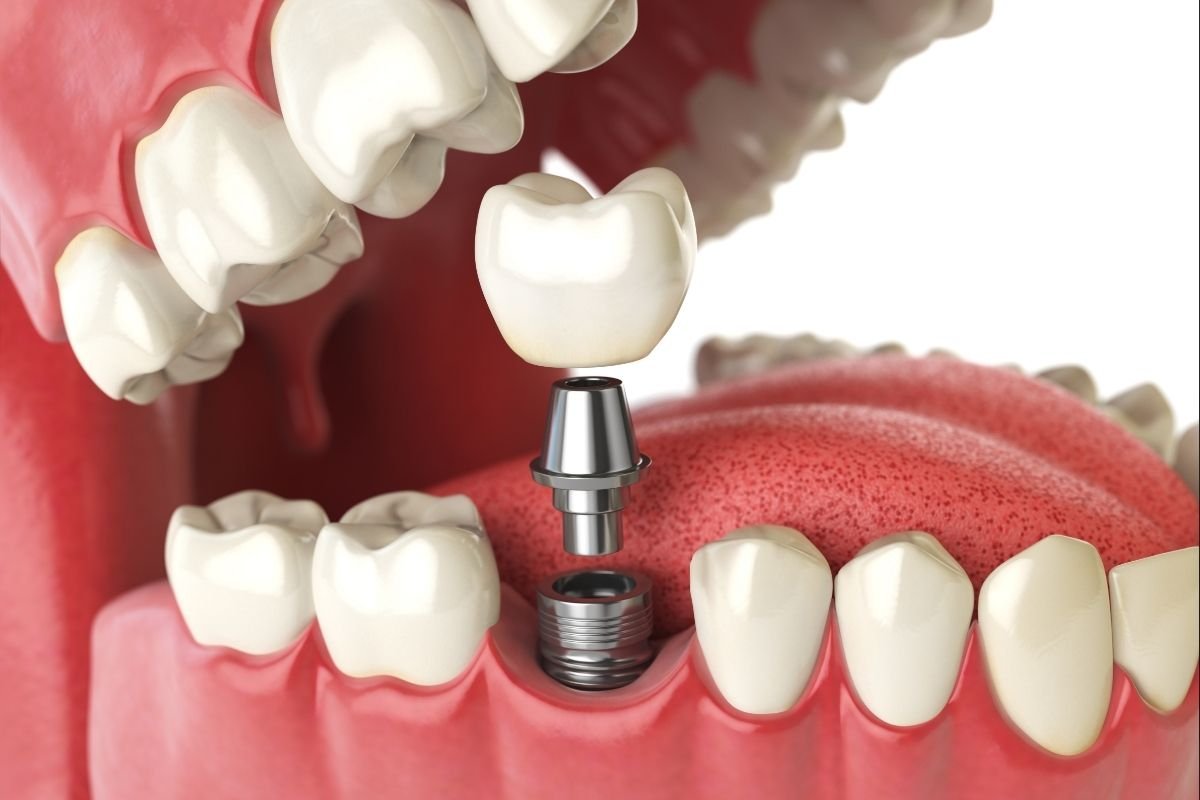 Dental Implants