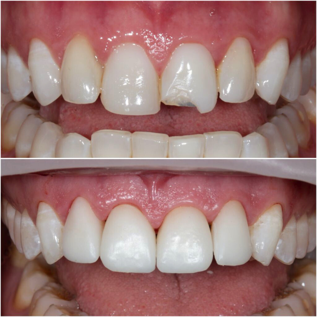3D Printed Veneers