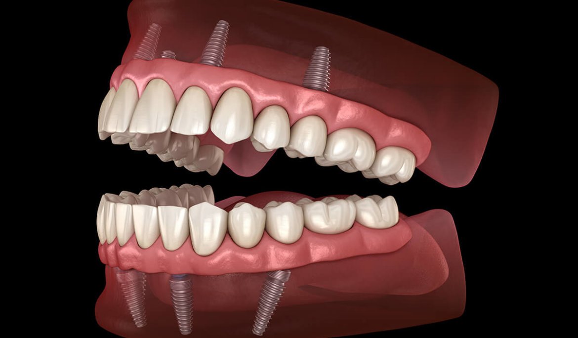 All-on-X Dental Implants