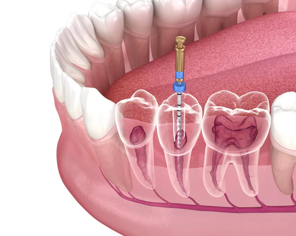 Root Canal Therapy in Mckinney TX