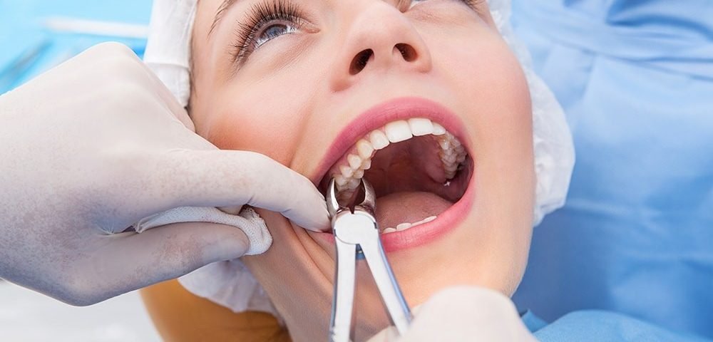 Tooth Extraction